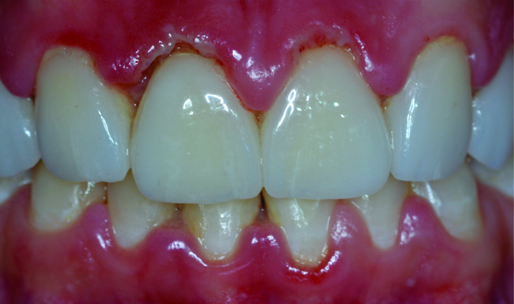 gengivite necrosante