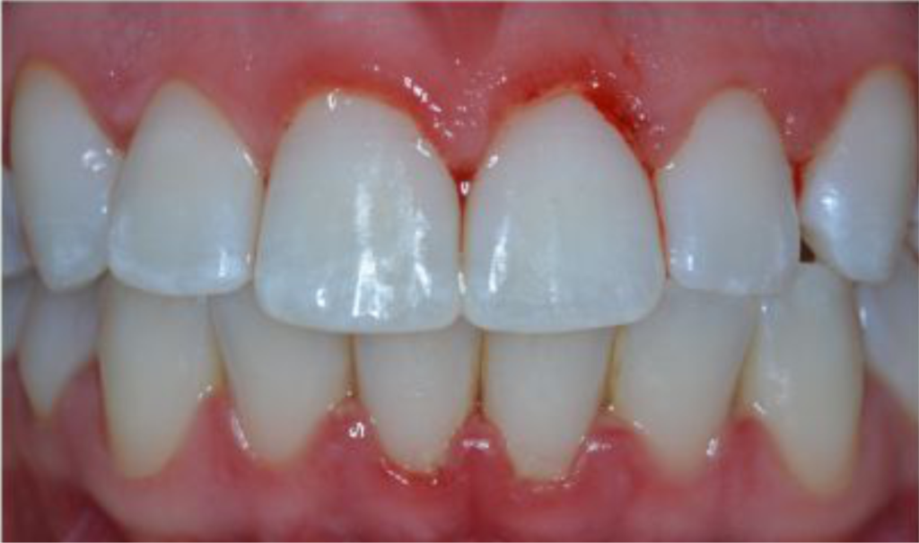 gengivite - gengival inflamada