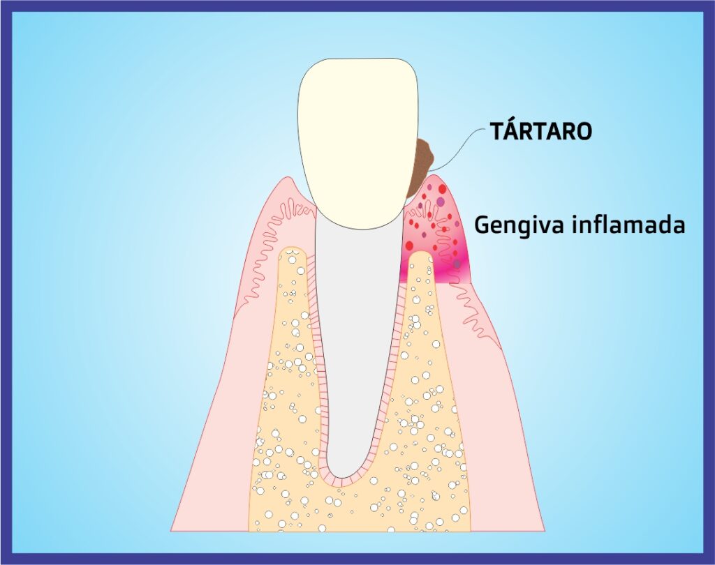 gengivite gengiva inflamada